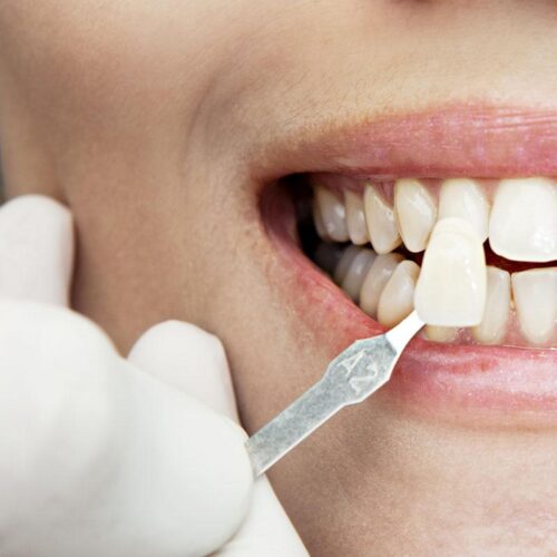 Examining a whiteness of teeth of a patient at the dentist